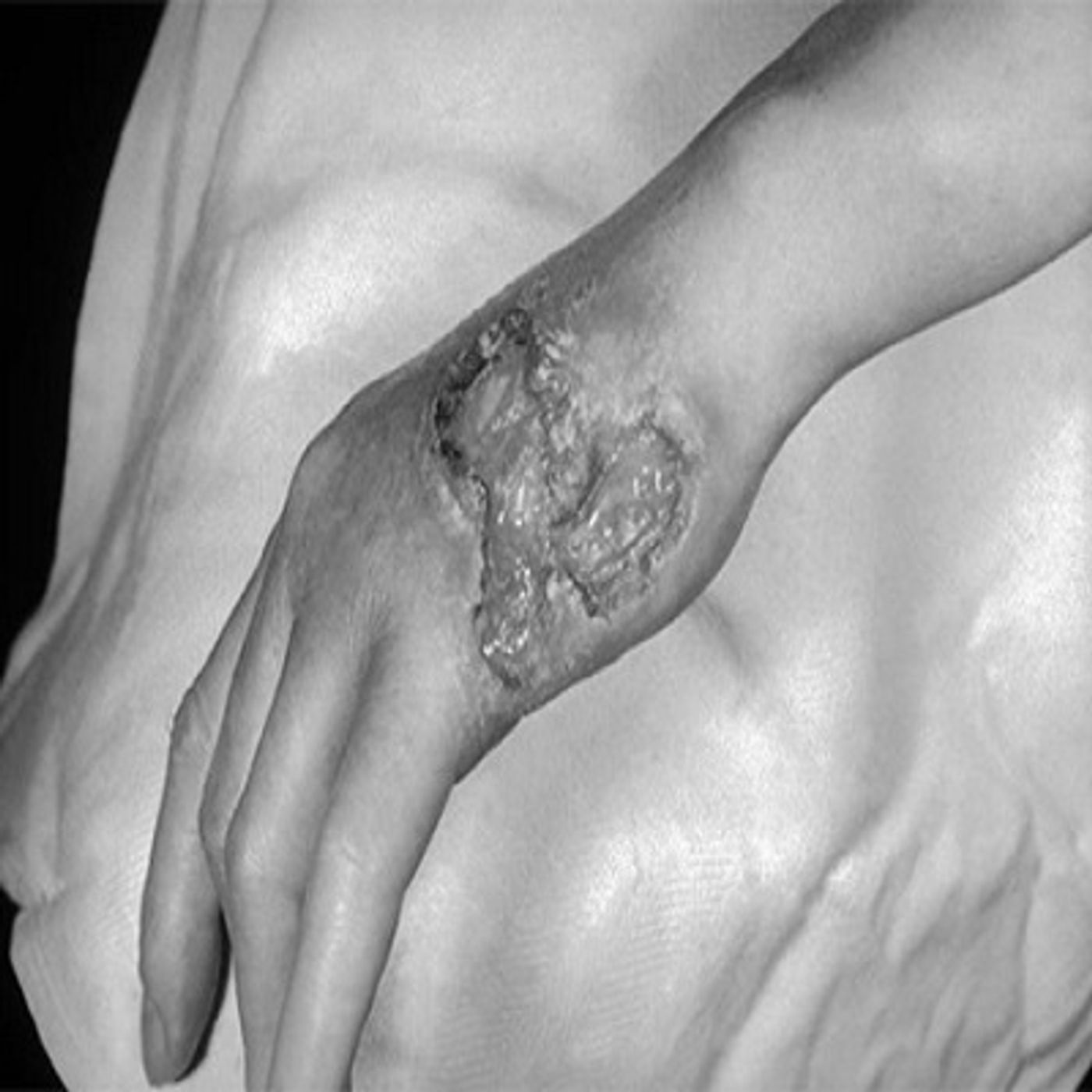 Gummatous Disease in Tertiary Syphilis