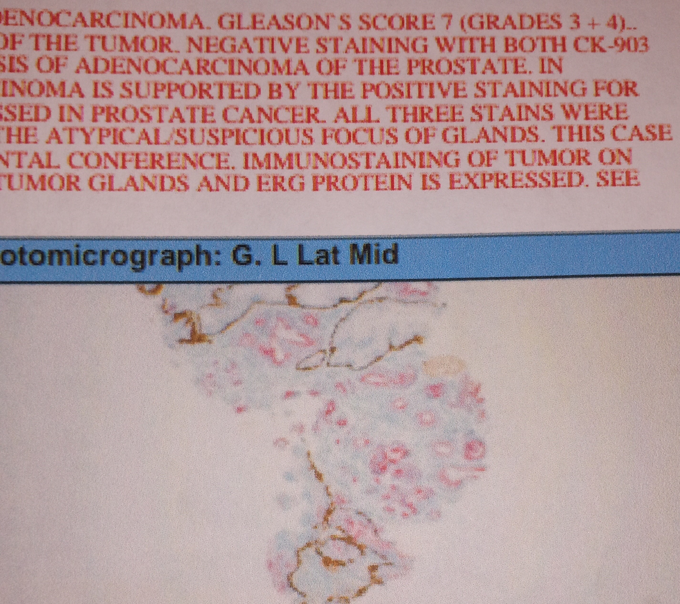 Cancer cells