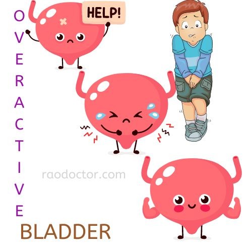 How To Manage Overactive Bladder Syndrome
