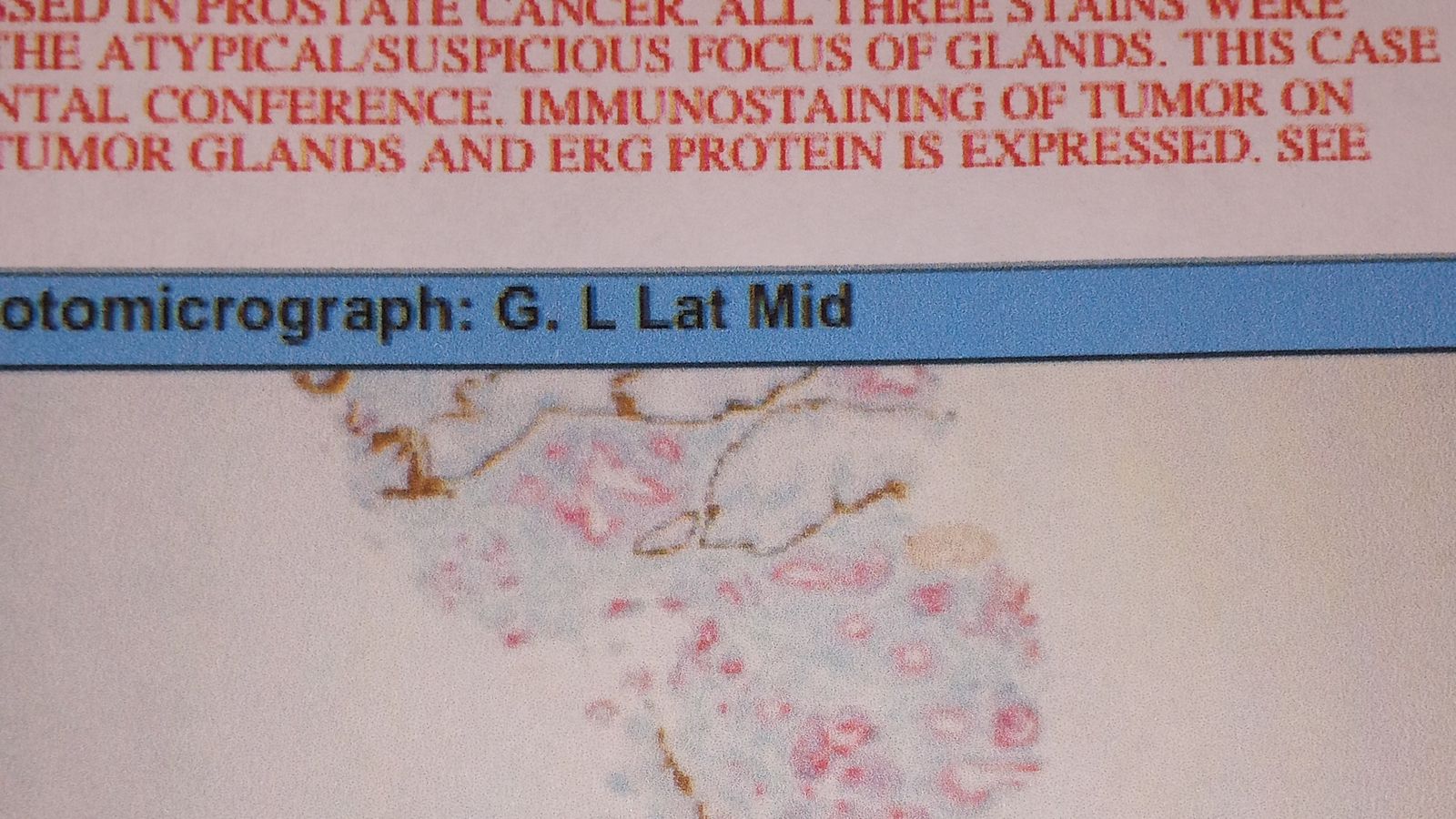 Cancer cells