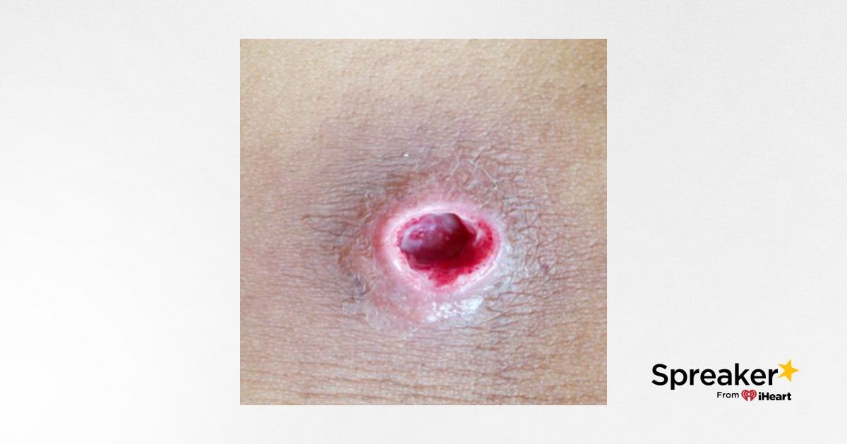 Abscess vs. Cyst vs. Boil: Key Differences Briefly Explained