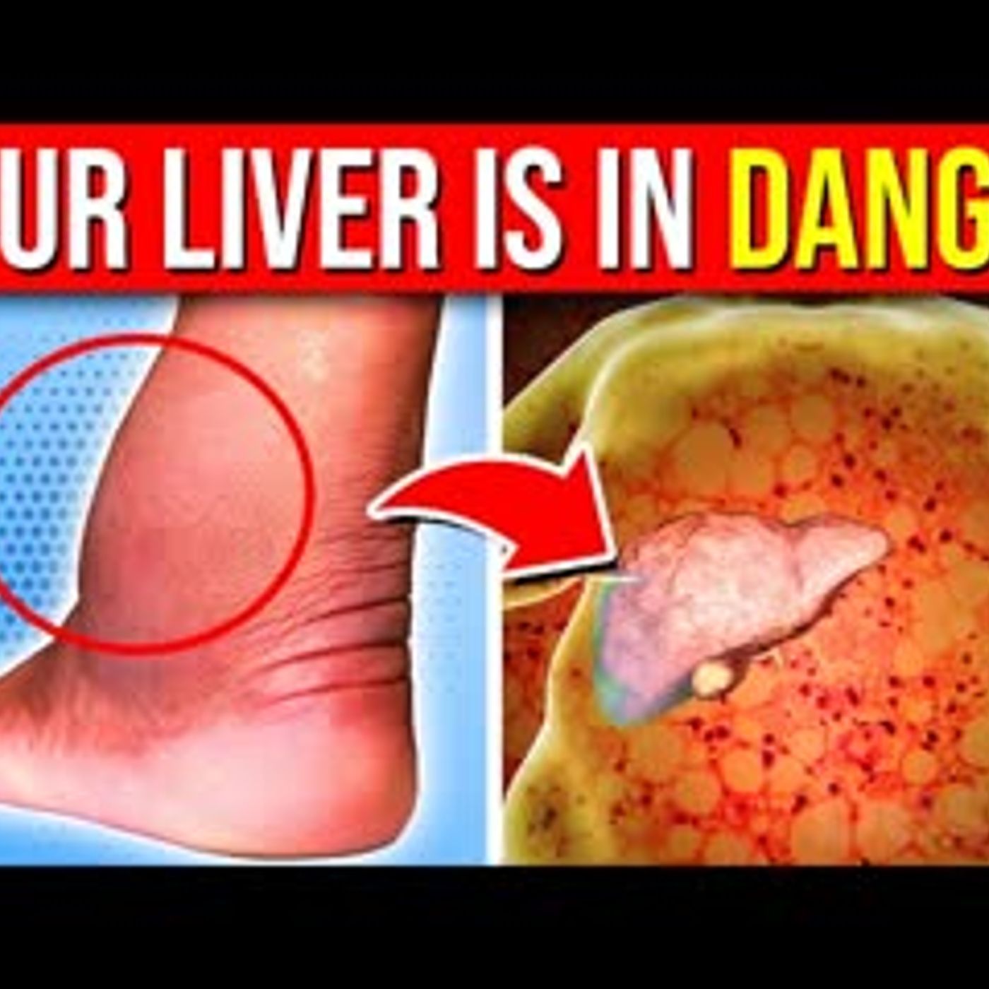 11 ALARMING Signs Of Liver Damage Your Body Is Warning You About episode artwork