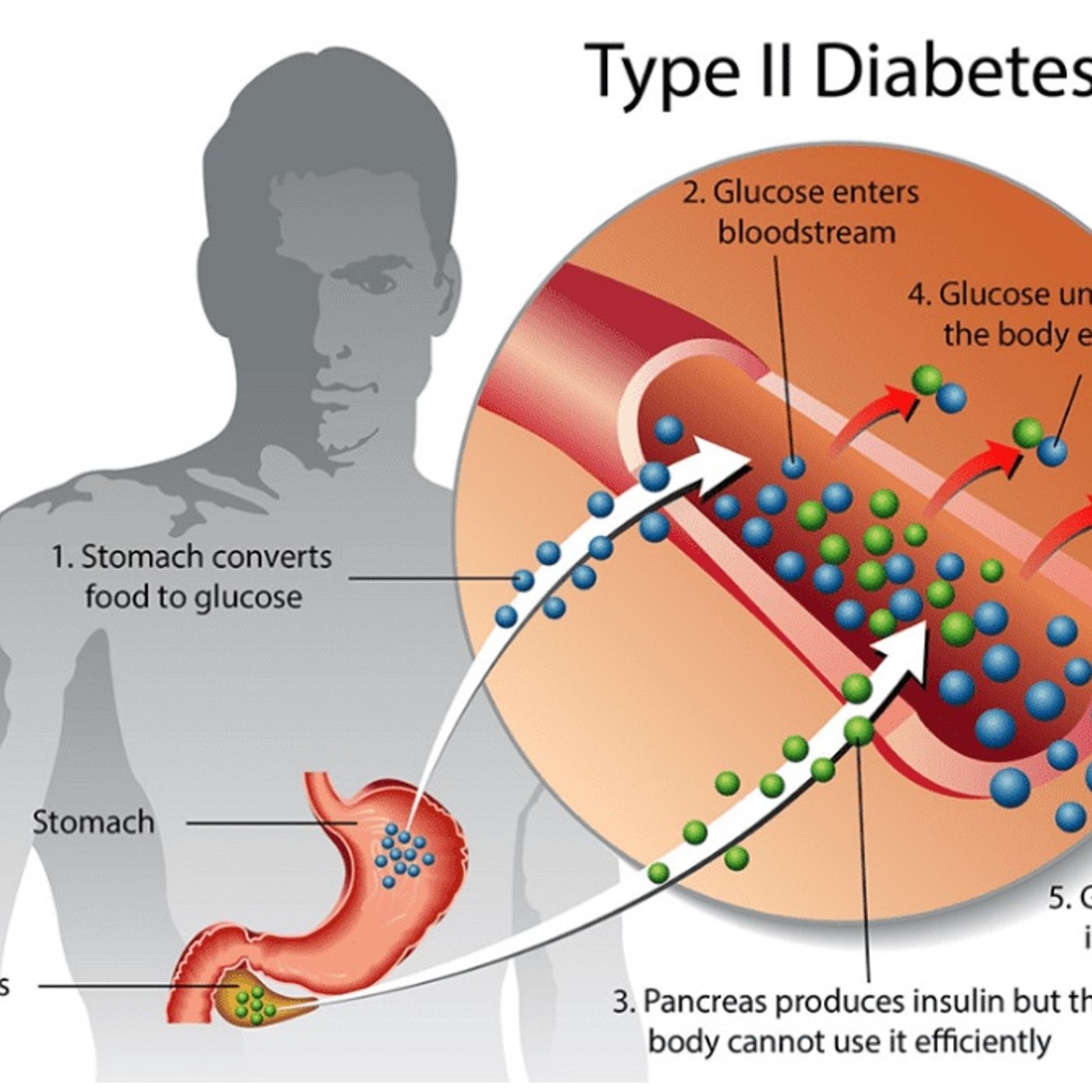 Type 2 Diabetes episode artwork
