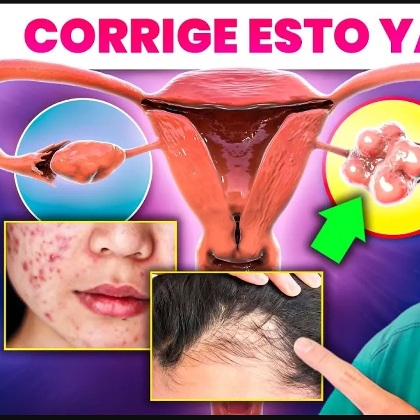 👩‍⚕️SÍNDROME de OVARIO POLIQUÍSTICO: NO mejorarás hasta SABER ESTO