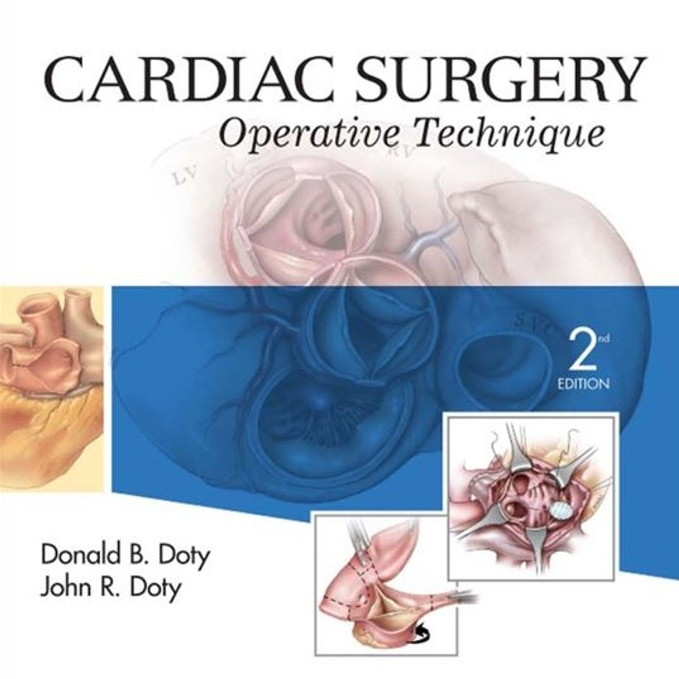 Cardiac Surgery: Operative Technique