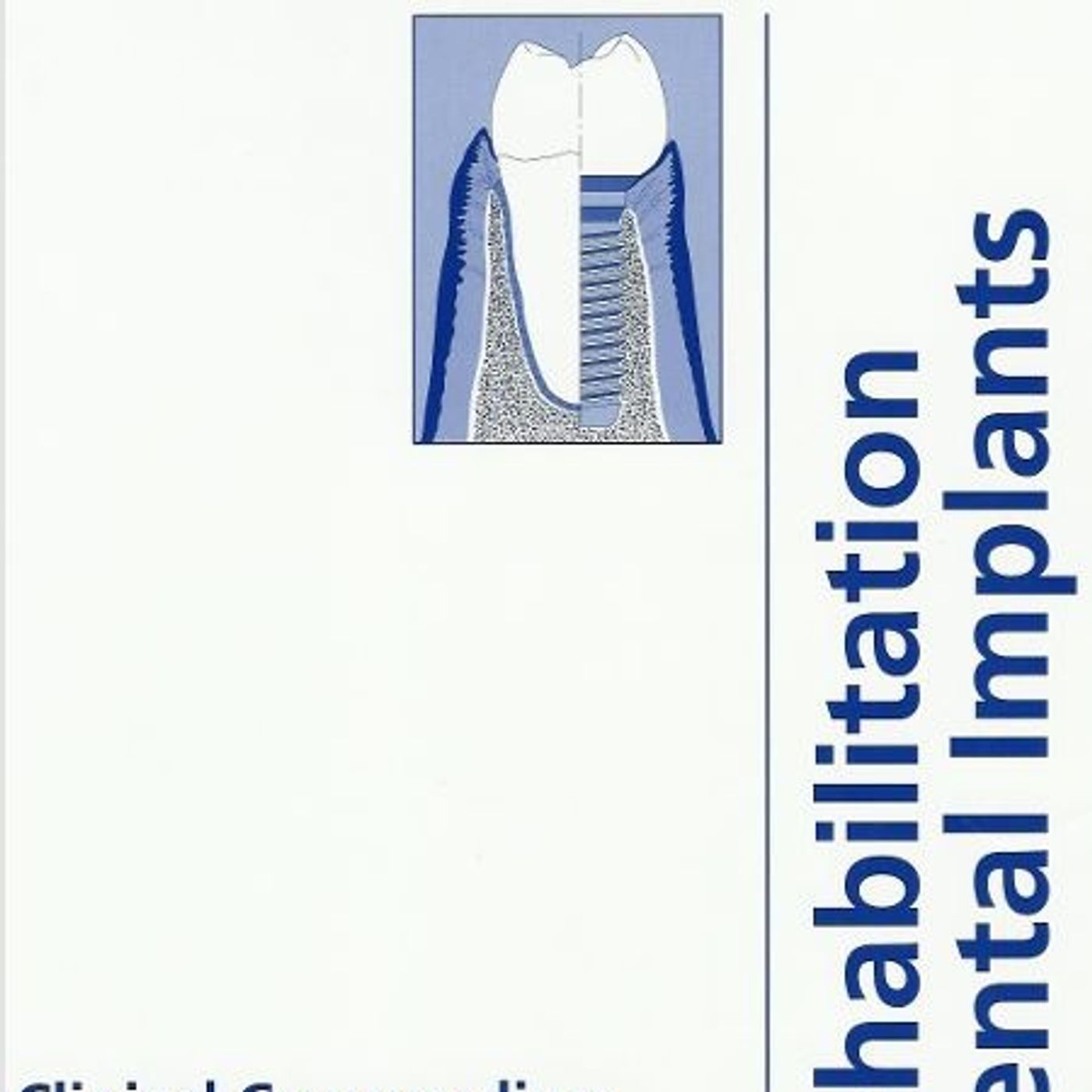 Oral Rehabilitation with Dental Implants