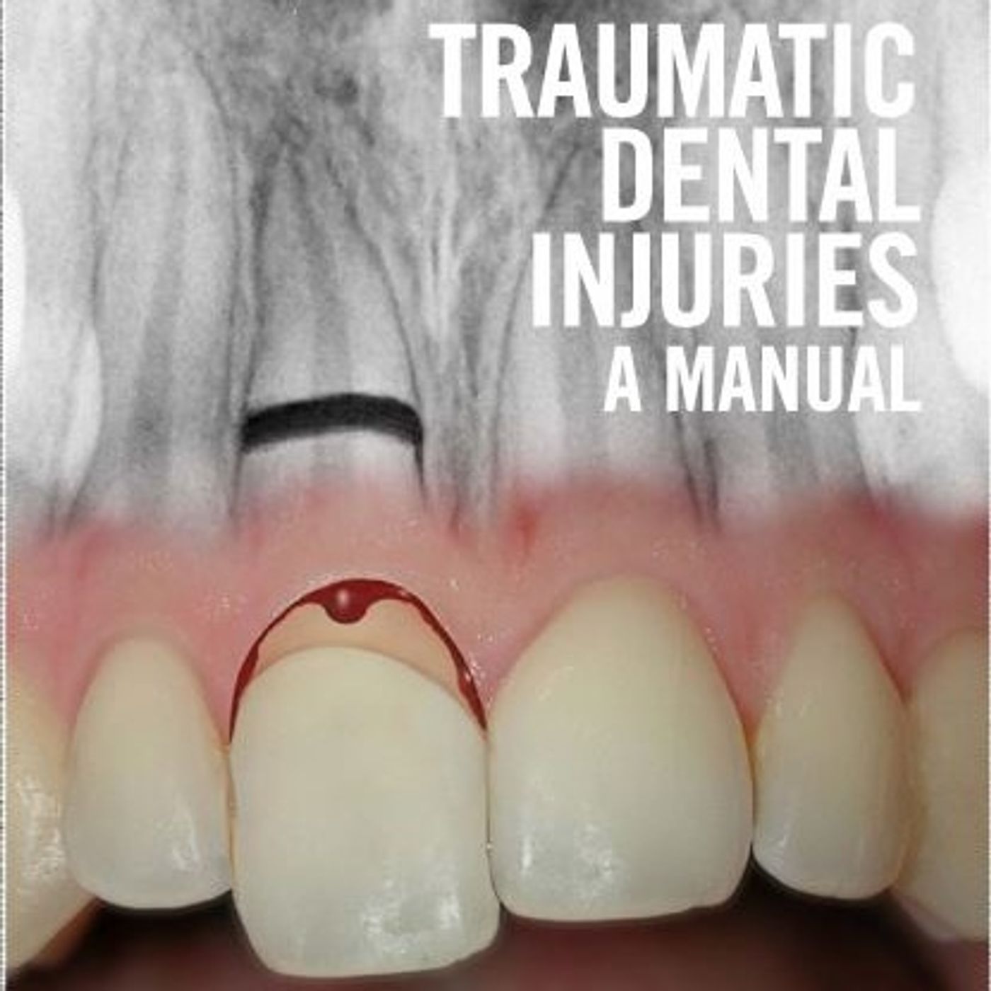 Traumatic Dental Injuries: A Manual