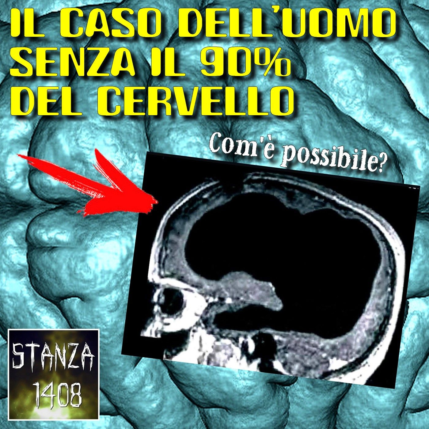 IL CASO DELL'UOMO SENZA IL 90% DEL CERVELLO (Stanza 1408 Podcast) episode artwork