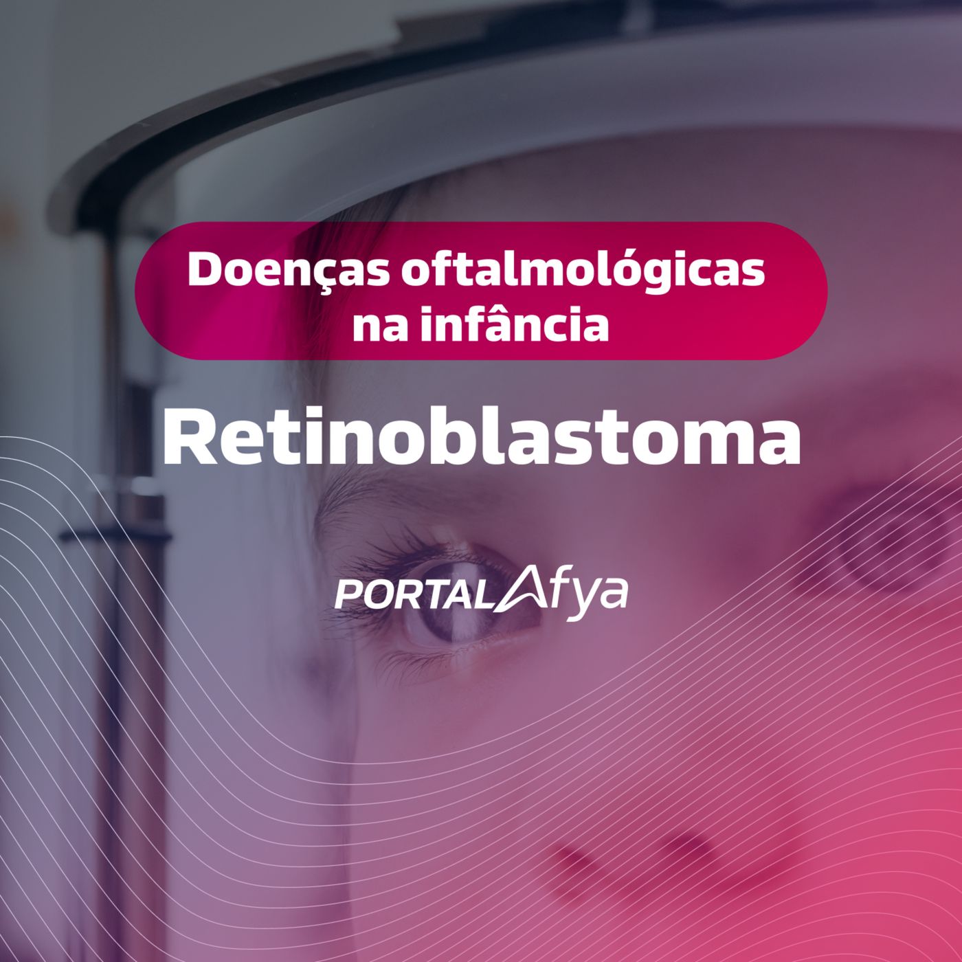 Podcast #134: Principais doenças oftalmológicas na infância: Retinoblastoma episode artwork