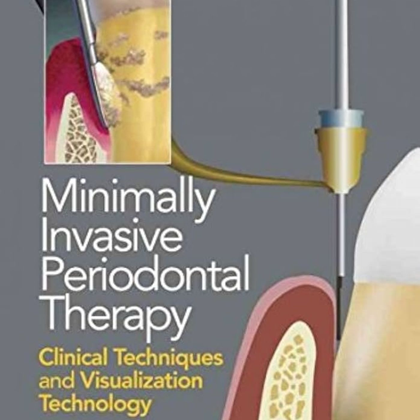 Minimally Invasive Periodontal Terapy Clinical Tecniques And Visualization Tecnology episode artwork