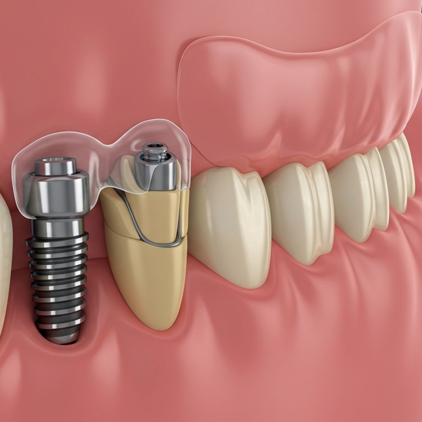Implant-Supported Overdentures A Game Changer for Your Smile episode artwork