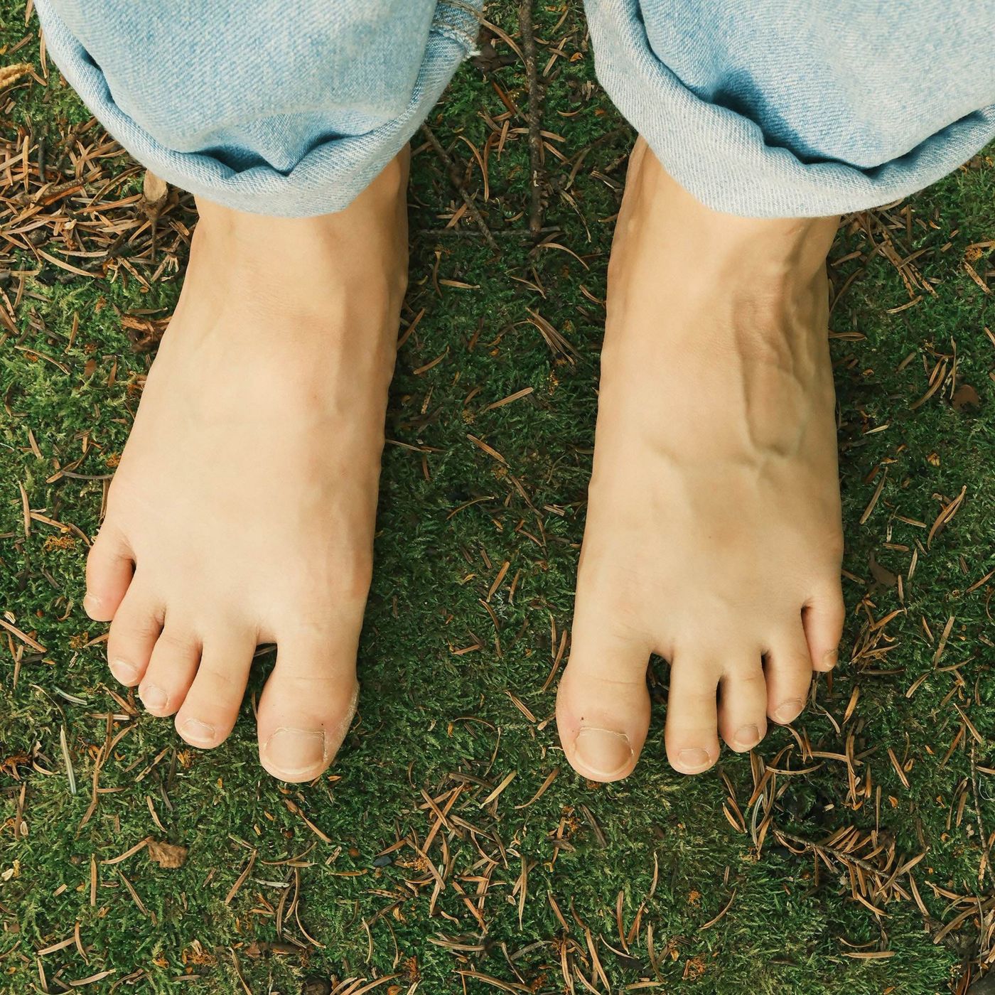 Sprinting to Restore the Arch: Correcting Flat Feet