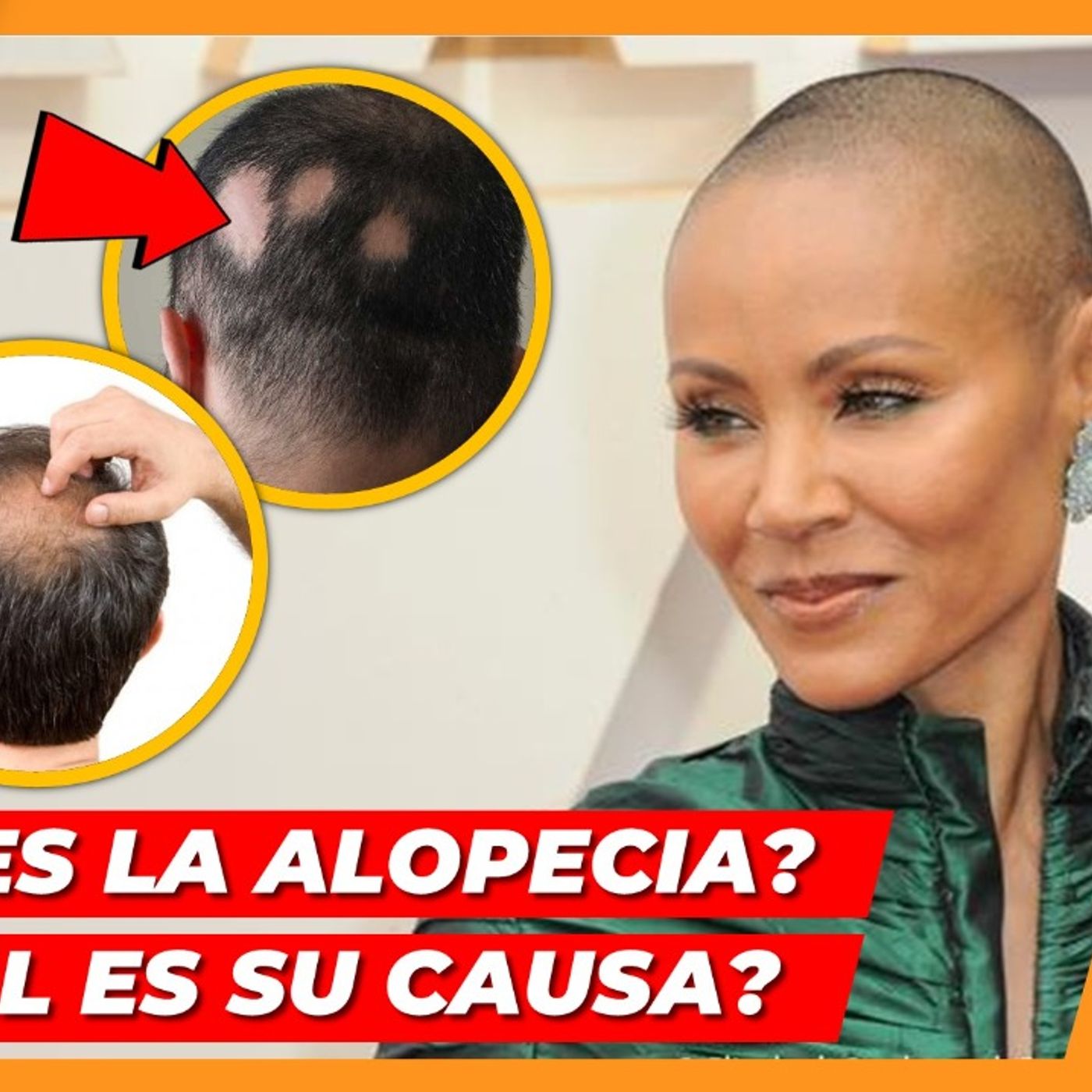 ¿QUÉ ES LA ALOPECIA Y CUÁL ES SU CAUSA  CUIDA TU SALUD episode artwork