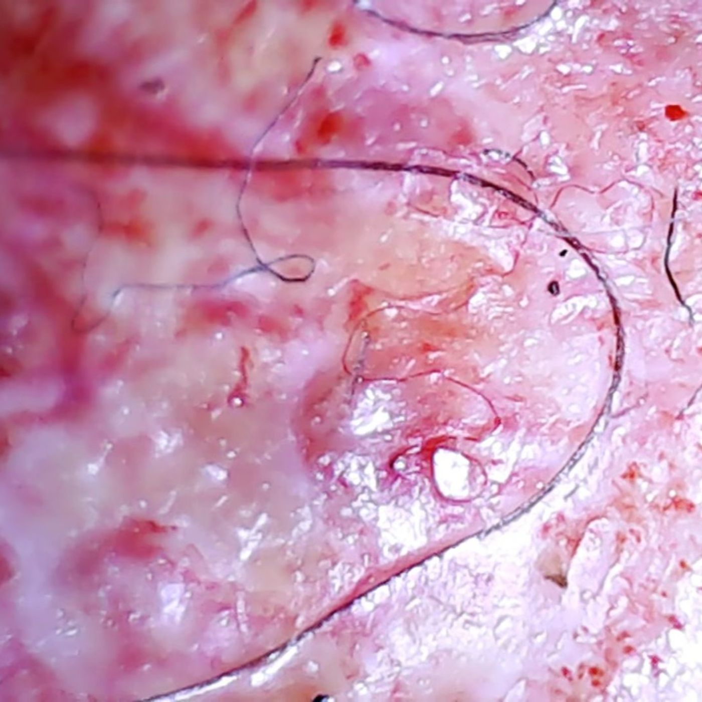 Morgellons Discussion