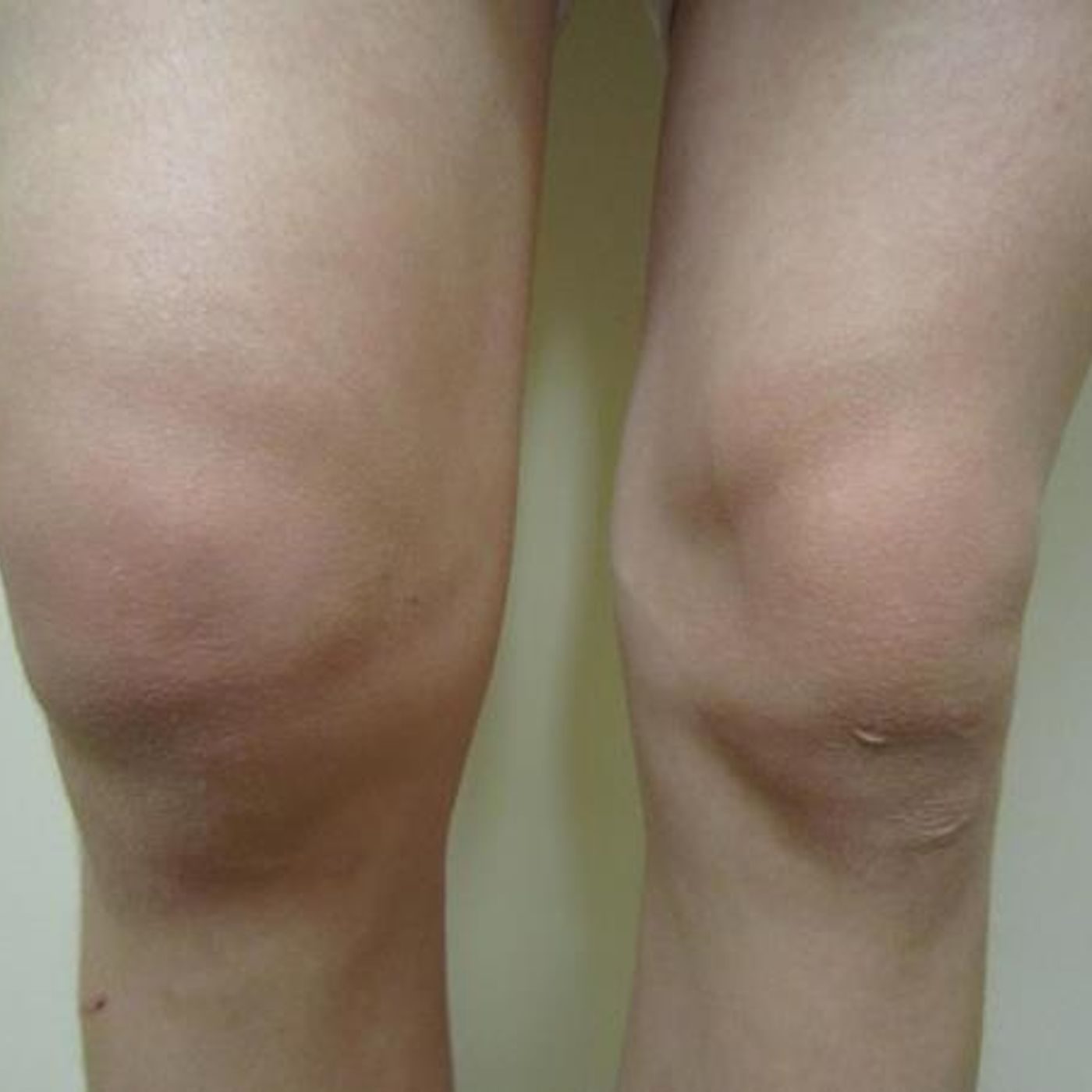 Survival Medicine Hour: Arthritis, Mass Recall, Anosmia