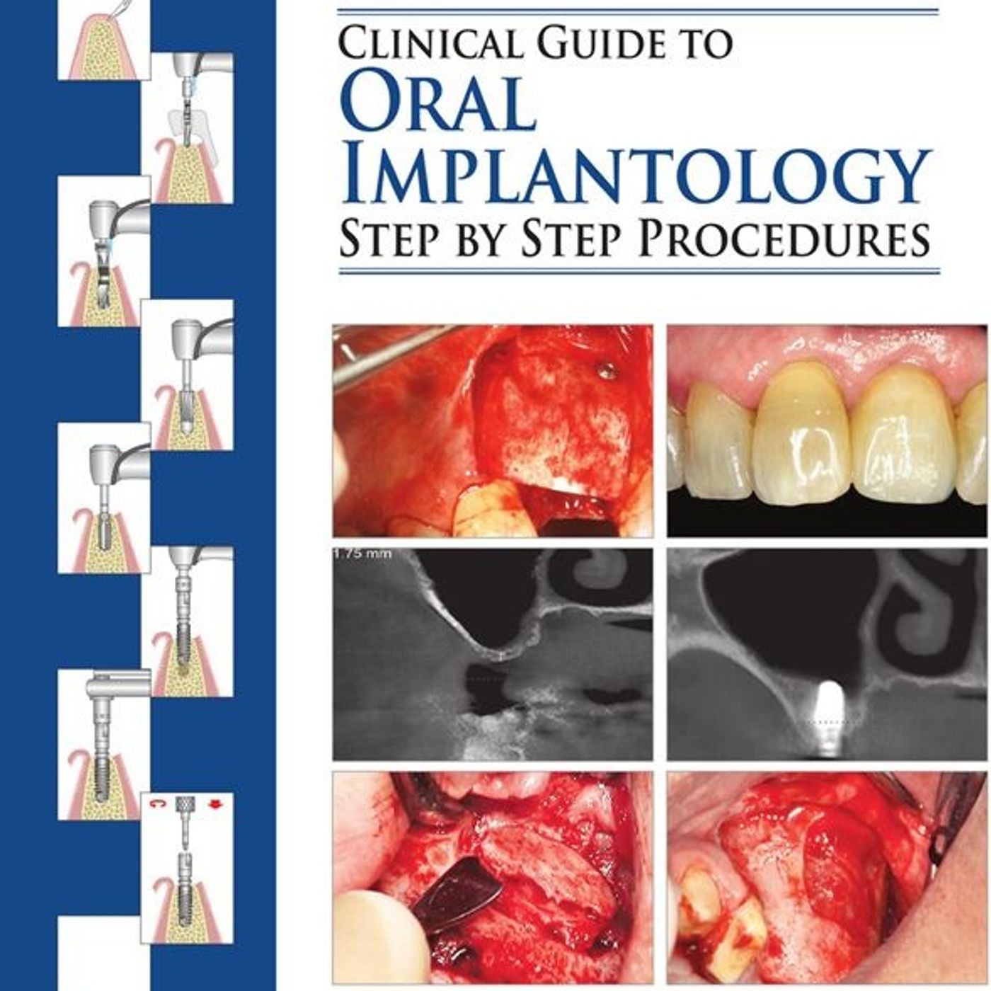 Clinical Guide to ORAL IMPLANTOLOGY: Step by Step Procedures