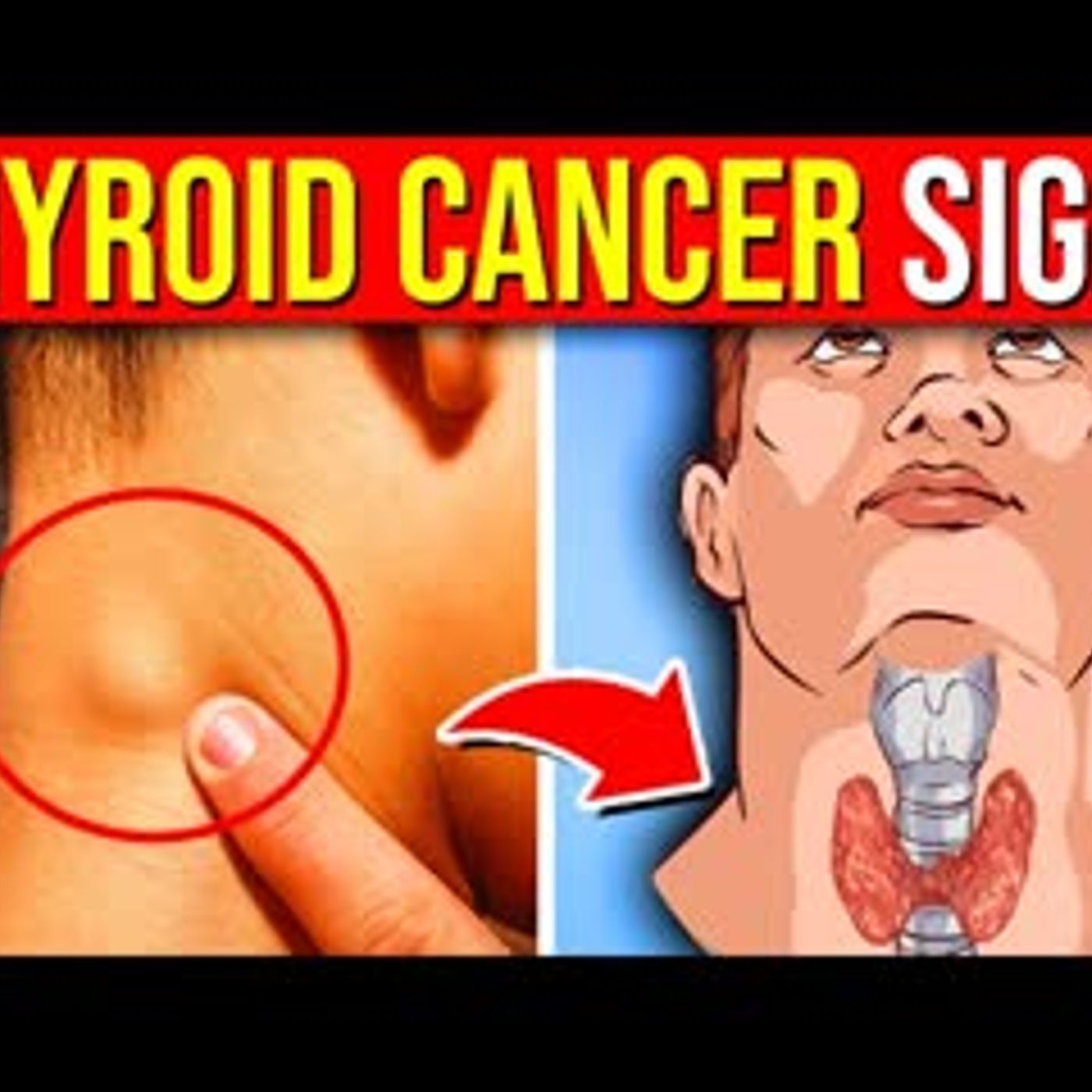 10 WARNING Signs Of Thyroid Cancer You Must Not IGNORE episode artwork