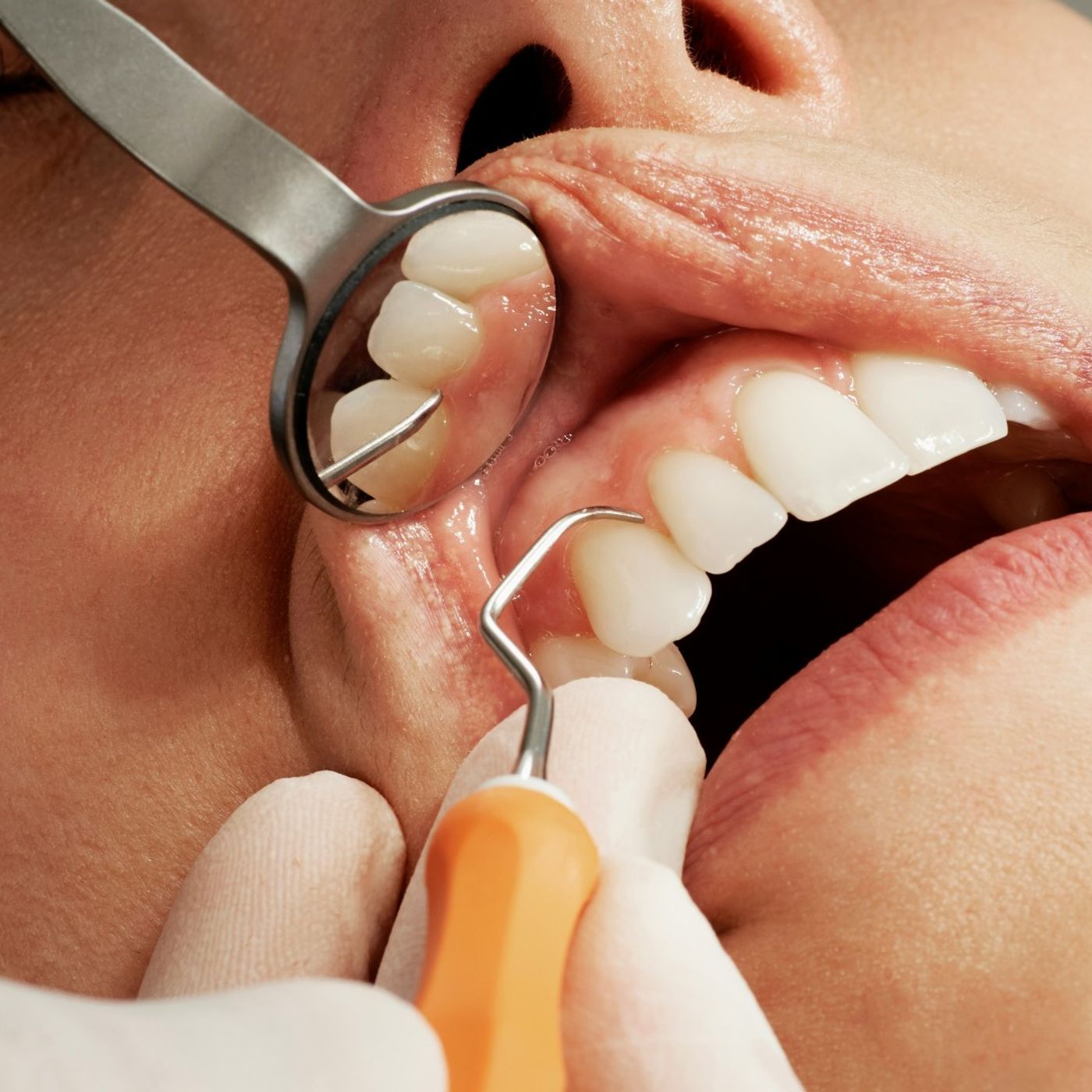 Tartaro, placca e pulizia annuale: i falsi miti dell'igiene dentale episode artwork