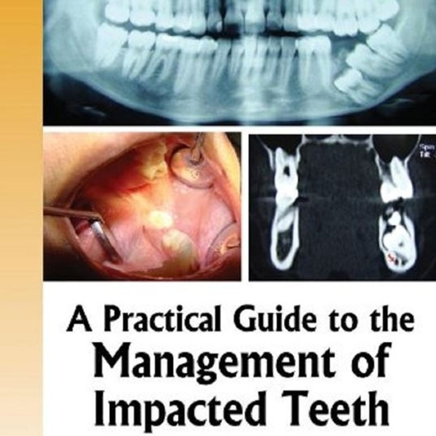 A  Practical Guide to the  Management of Impacted Teeth