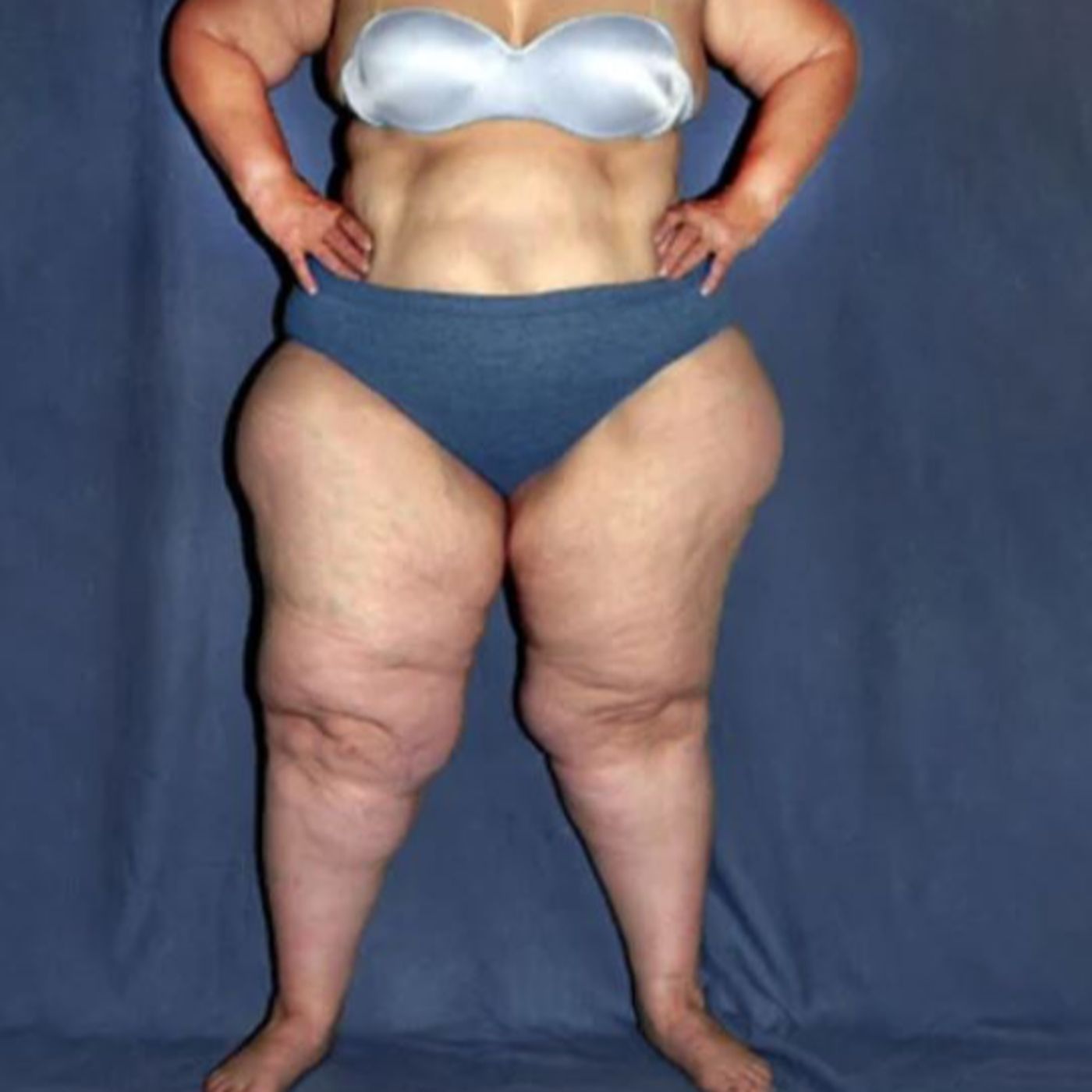 ¿Cómo miles de mujeres viven con lipedema en Chile sin diagnóstico ni cifras oficiales? episode artwork