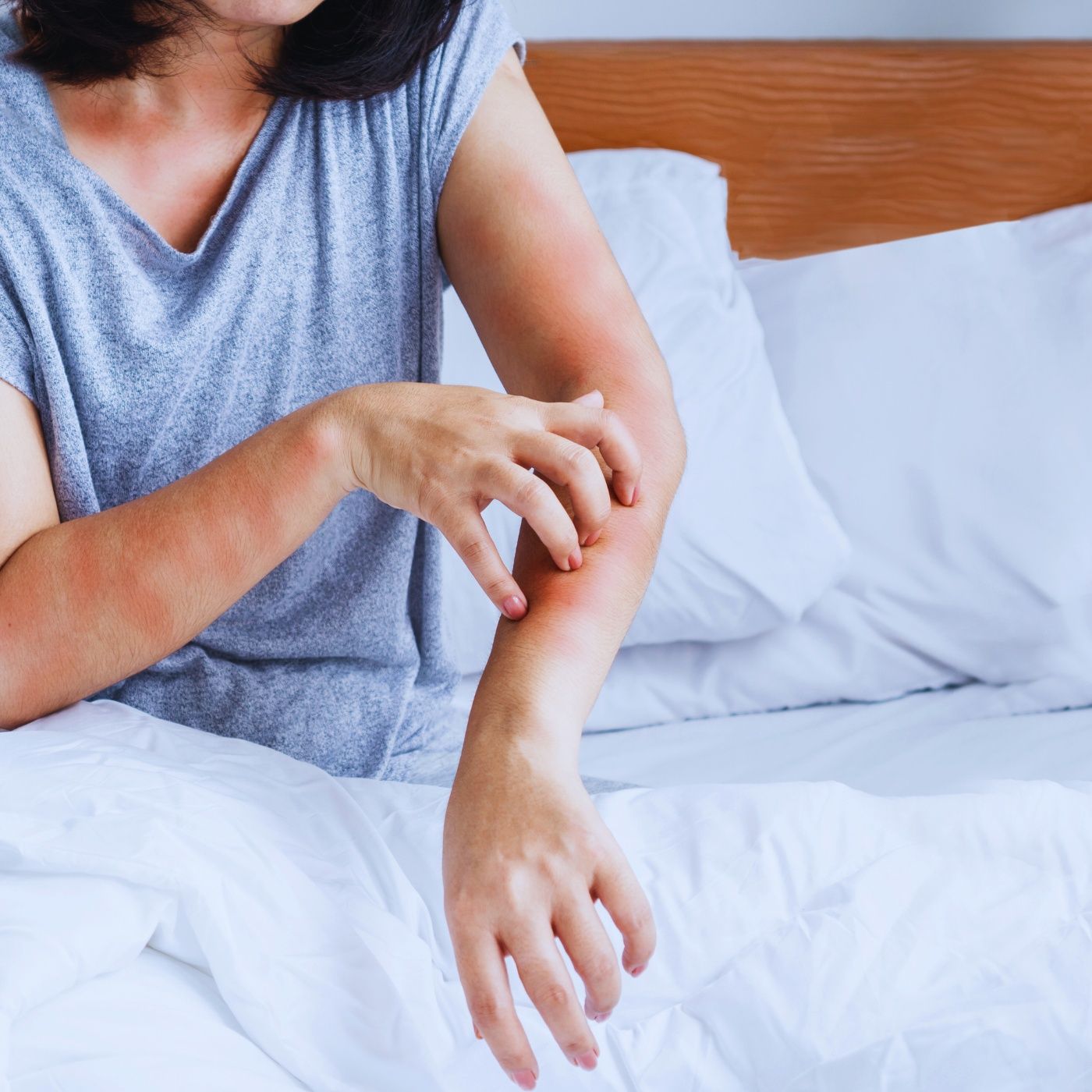 Handling Allergic Reactions to Essential