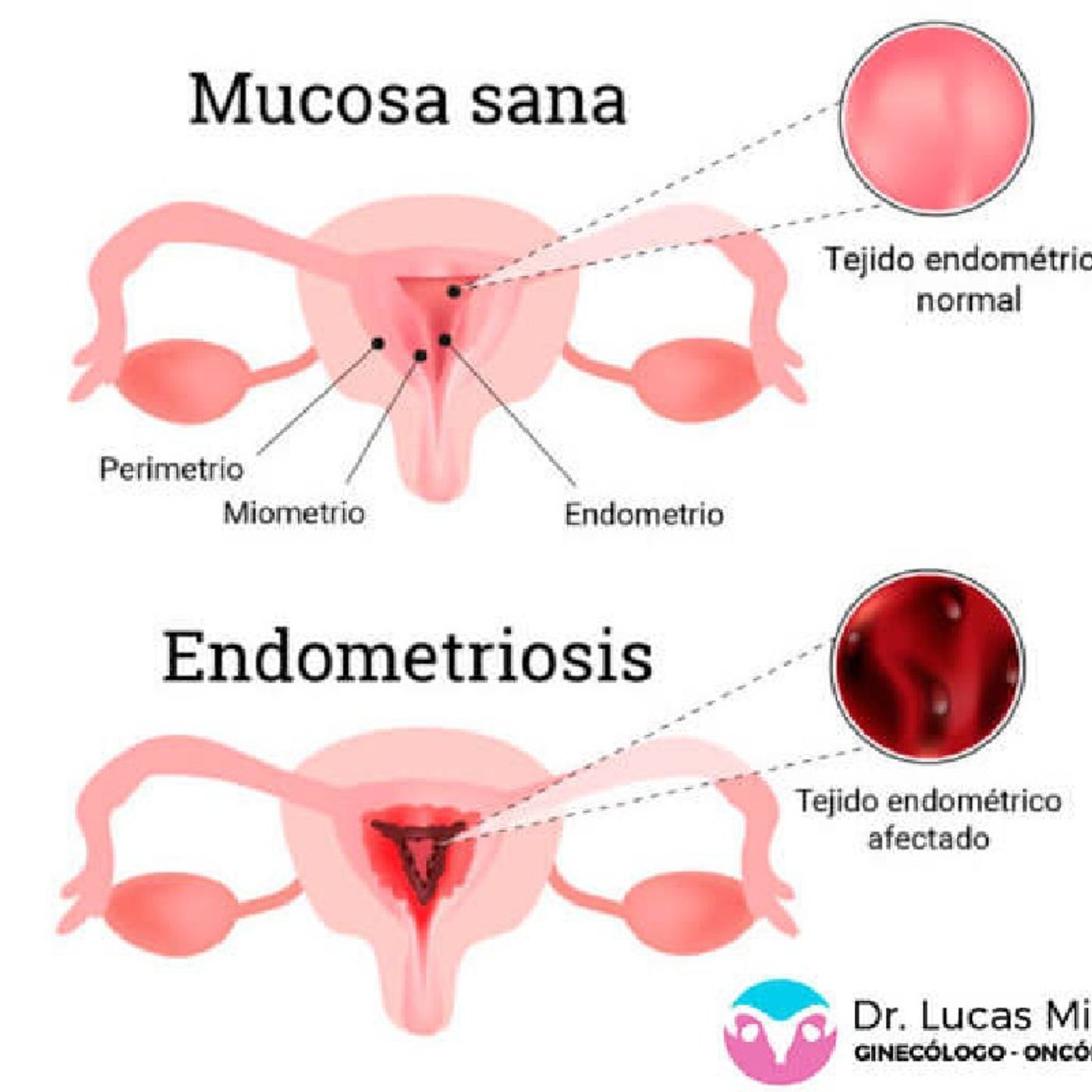 LA ENDOMETRIOSIS episode artwork