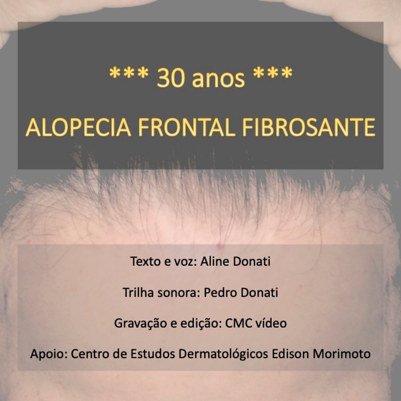 Alopecia frontal fibrosante 30 anos
