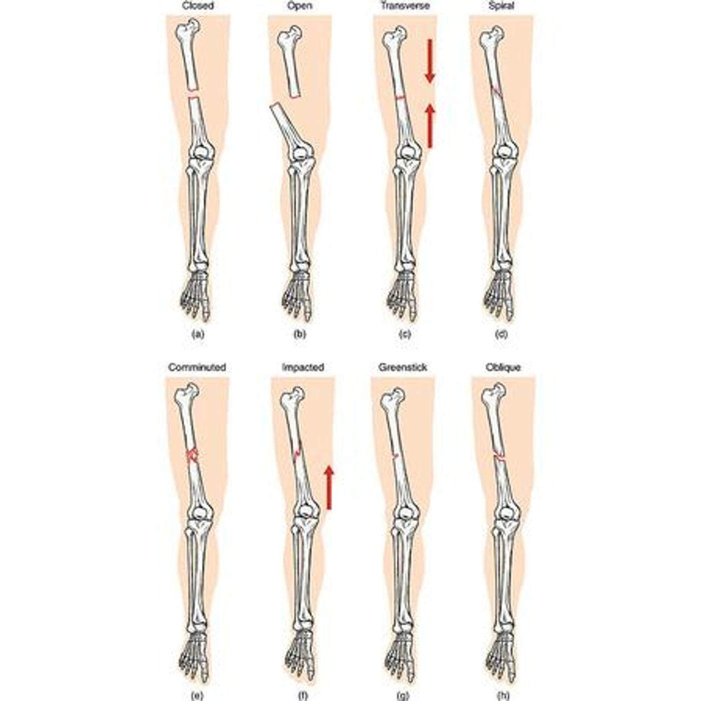 Survival Medicine Hour: Poison Plants, Bone Fractures, Traction, Casts, More
