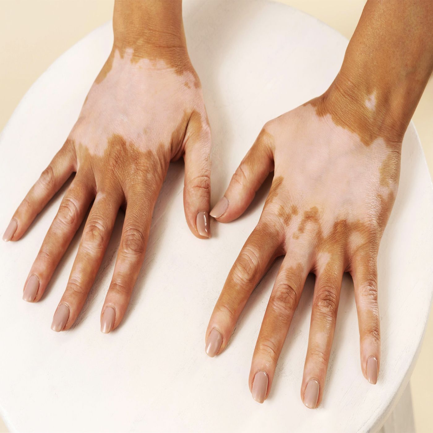 Vitiligo episode artwork