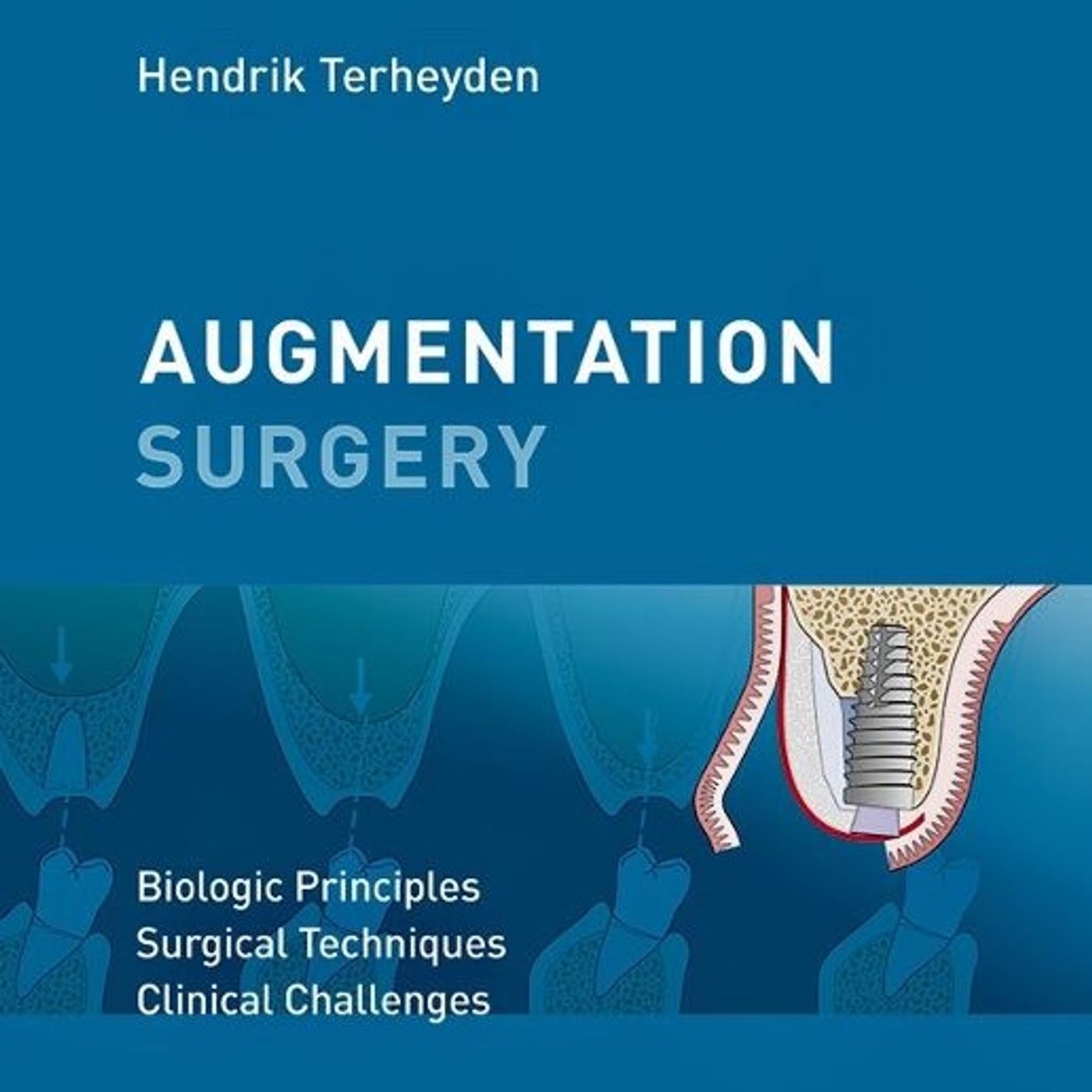 Augmentation Surgery