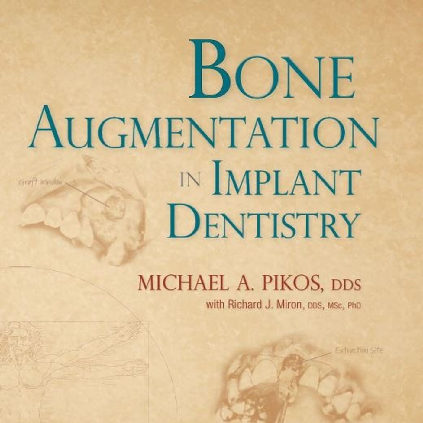 Bone Augmentation in Implant Dentistry: A Step-by-Step Guide to Predictable Alveolar Ridge and Sinus Grafting