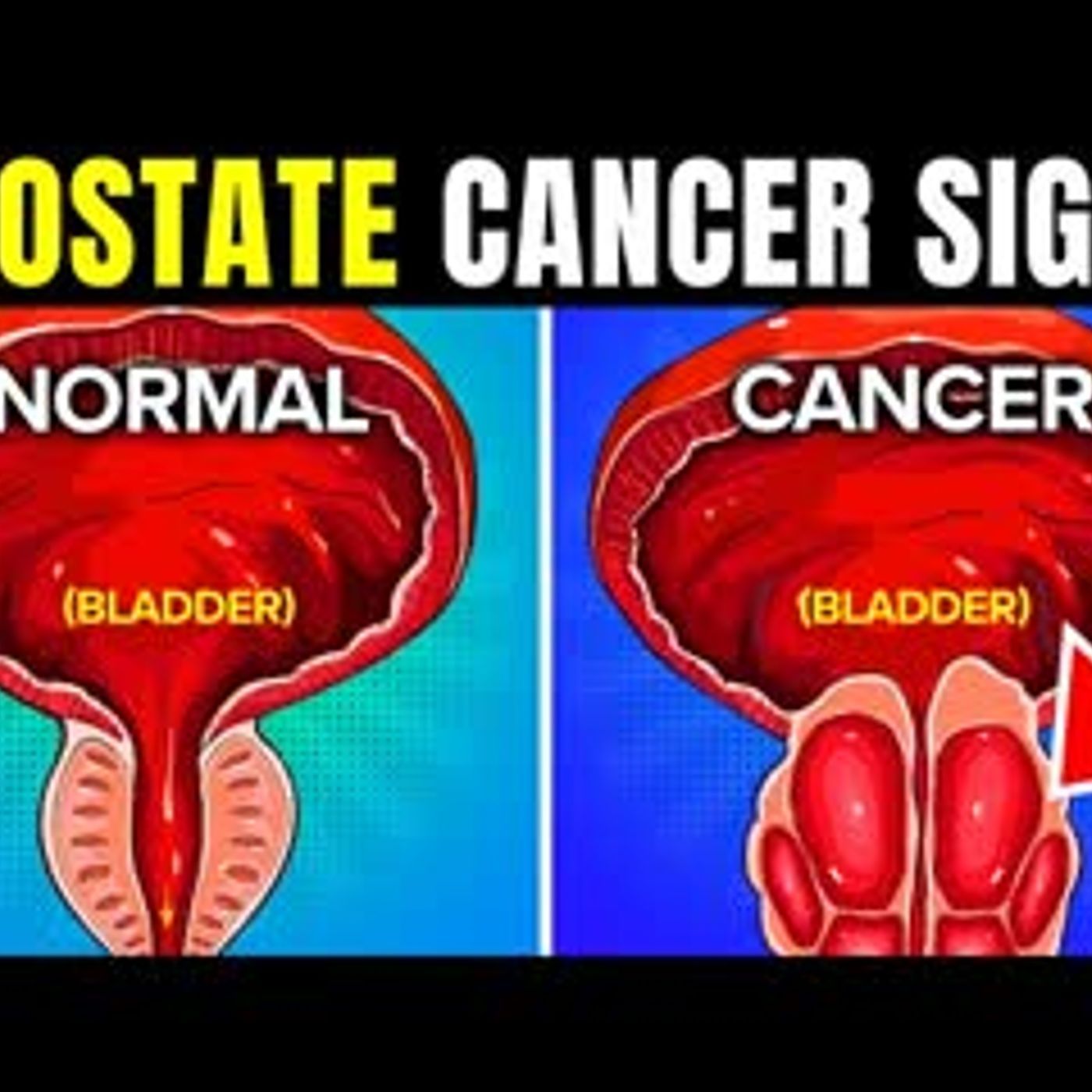 10 Warning Signs You May Have Prostate Cancer episode artwork