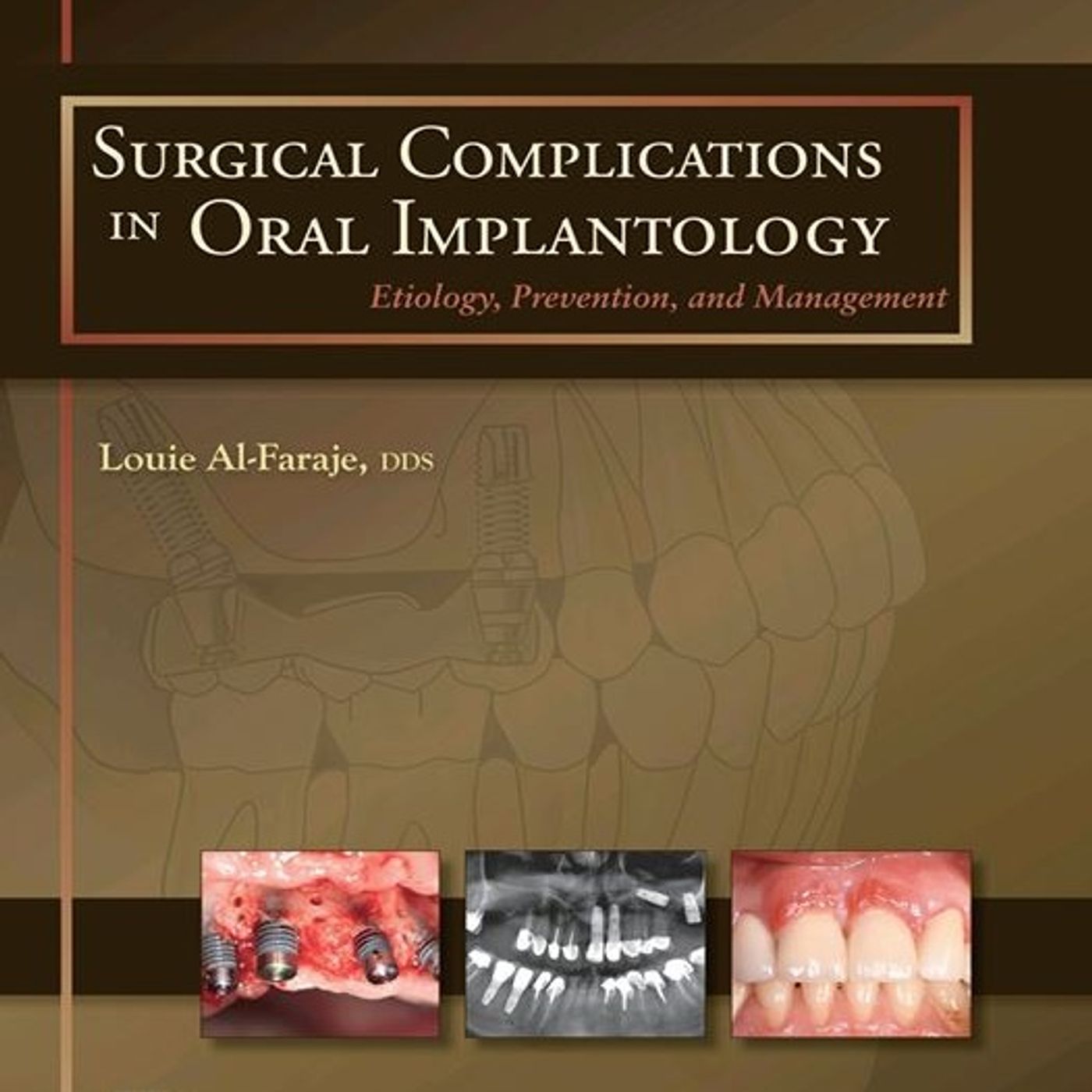 Surgical Complications in Oral Implantology: Etiology, Prevention, and Management