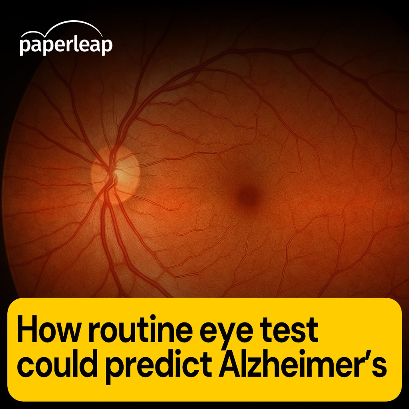 How routine eye test could predict Alzheimer’s
