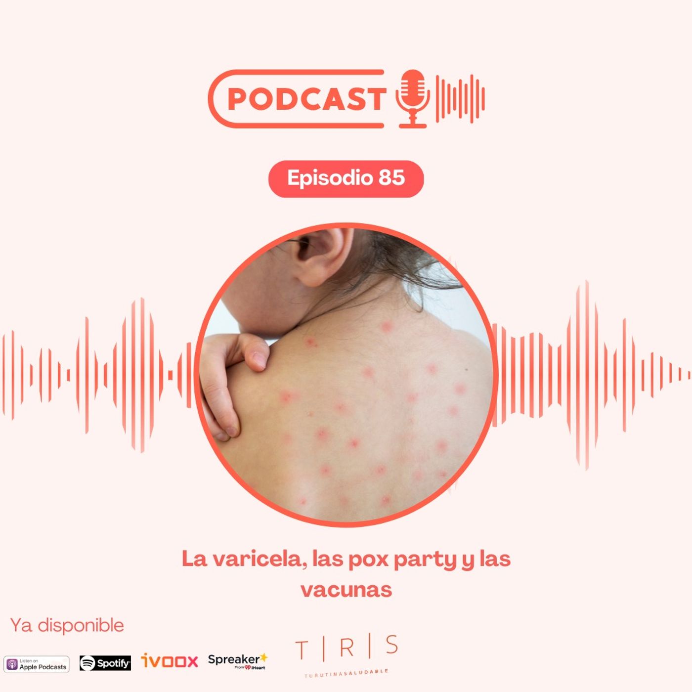 85 - La varicela, las pox party y las vacunas