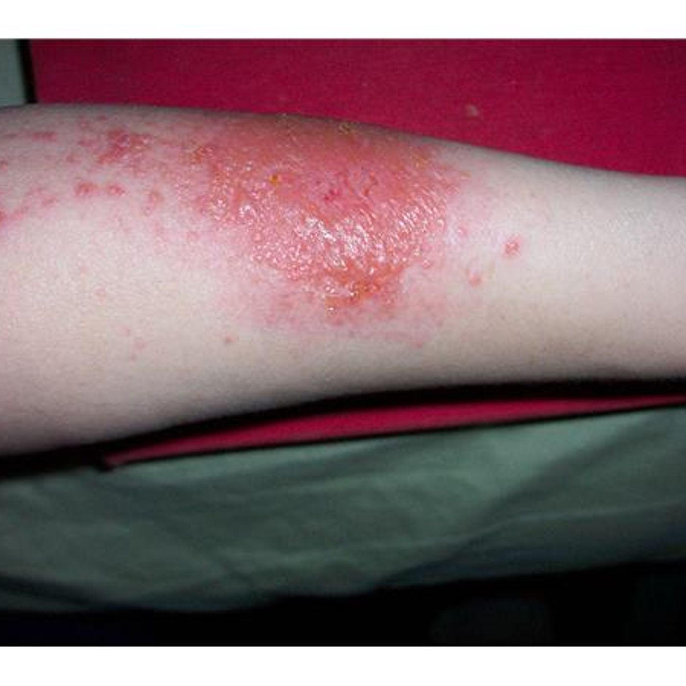 Survival Medicine Hour: Poison Plants, Setting a Fracture, More