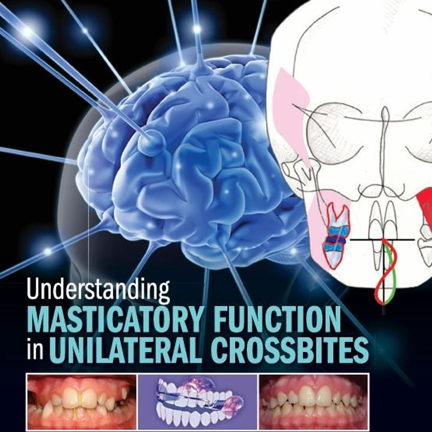 Understanding Masticatory Function in Unilateral Crossbites