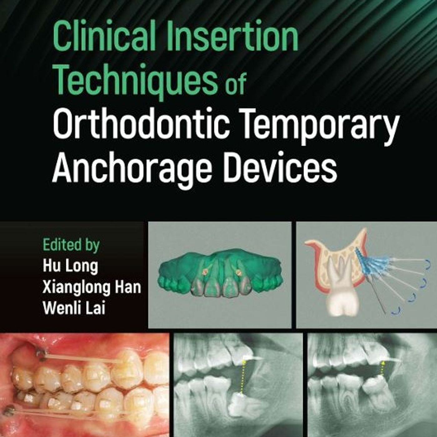 Clinical Insertion Techniques of Orthodontic Temporary Anchorage Devices