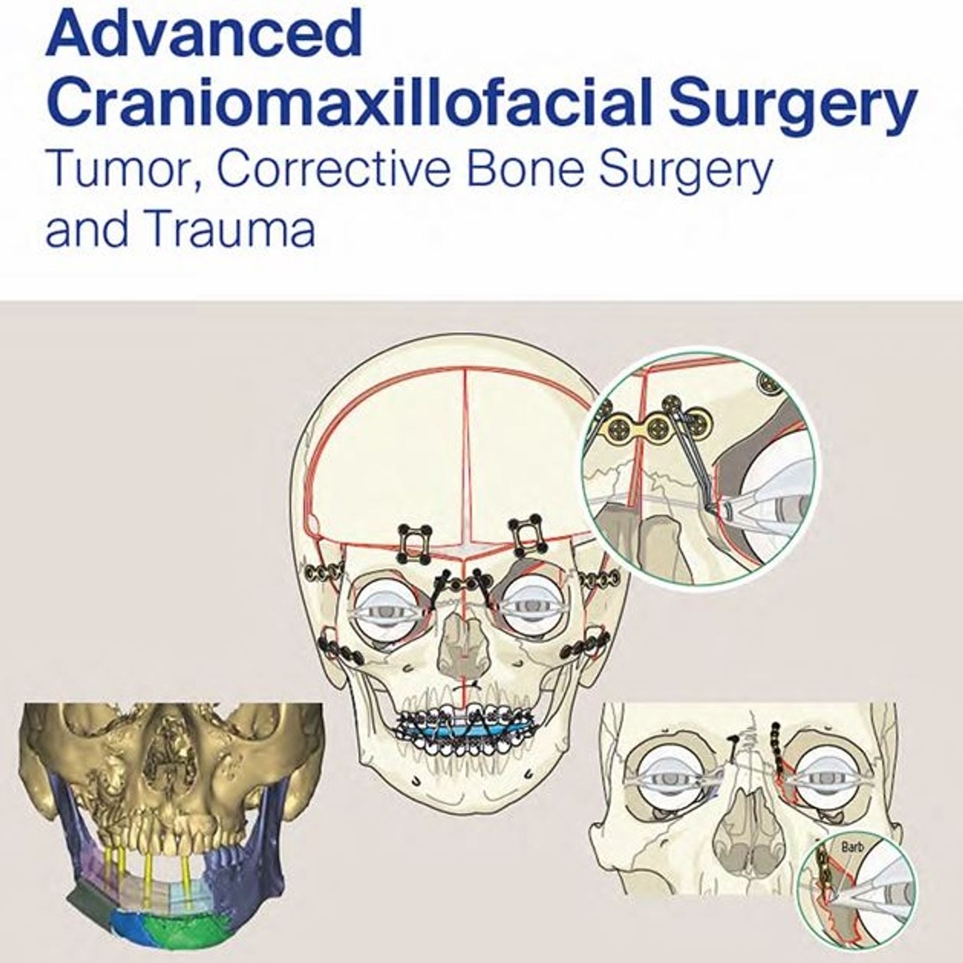 Advanced Craniomaxillofacial Surgery: Tumor, Corrective Bone Surgery and Trauma