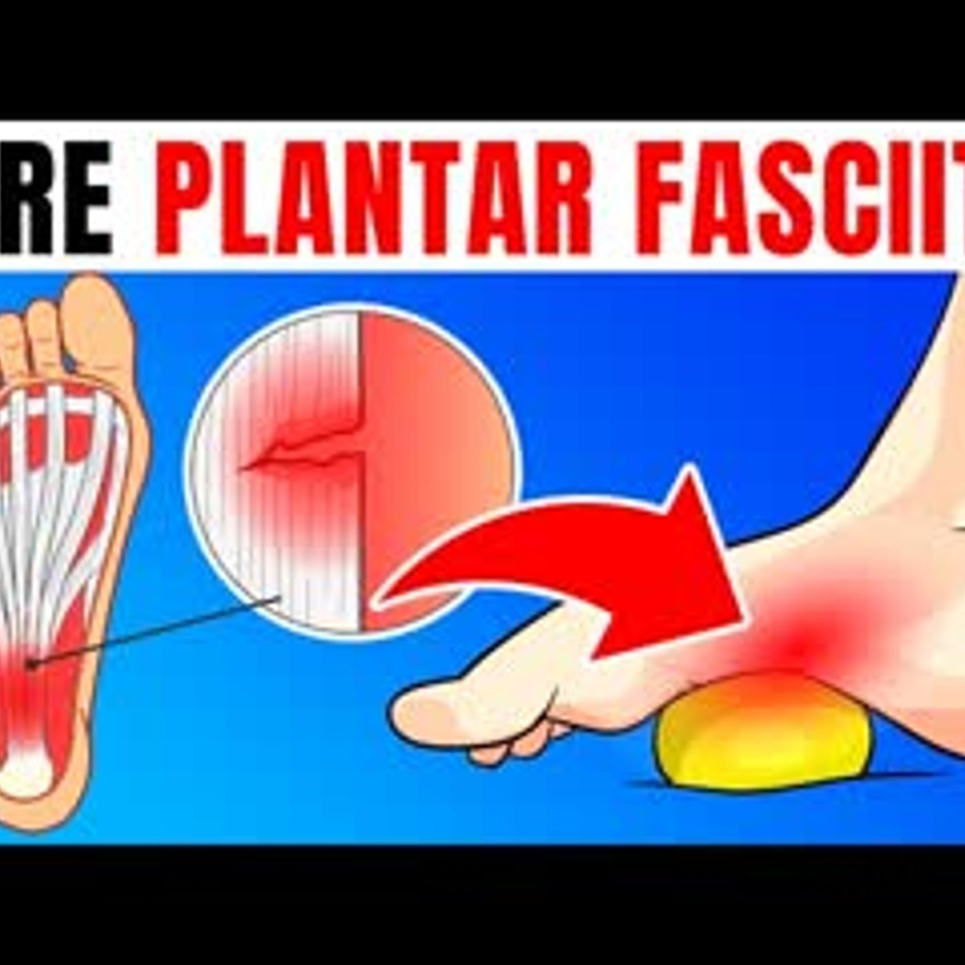 10 Proven Tips For Immediate Relief From Plantar Fasciitis episode artwork