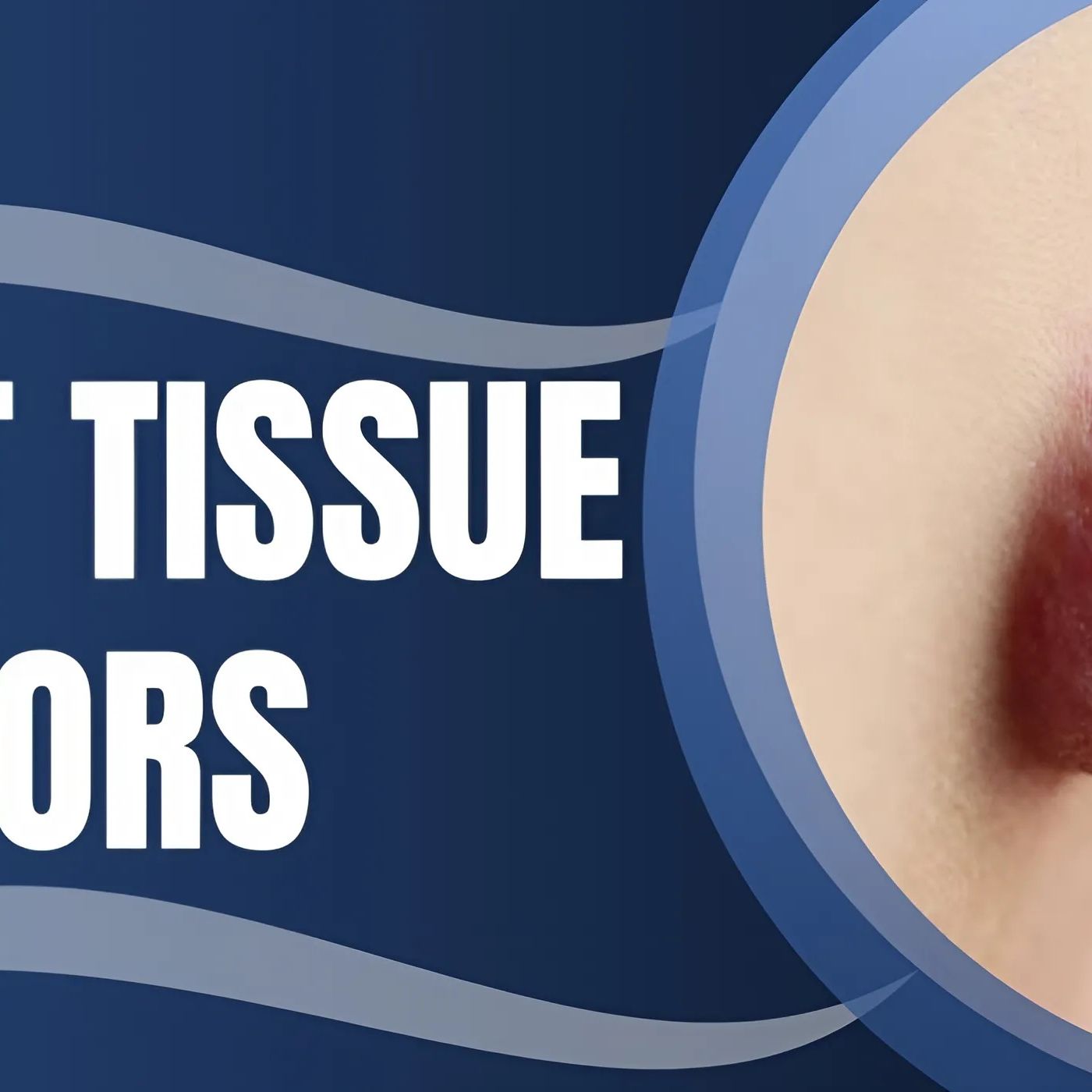 How Can Parents Spot Soft Tissue Tumors in Children episode artwork