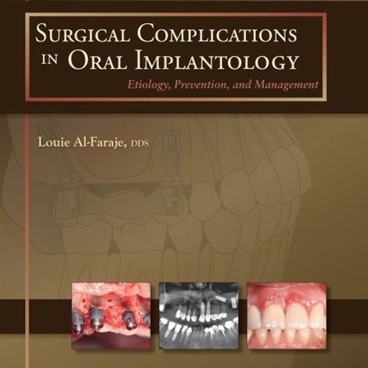 Surgical Complications in Oral Implantology: Etiology, Prevention and Management