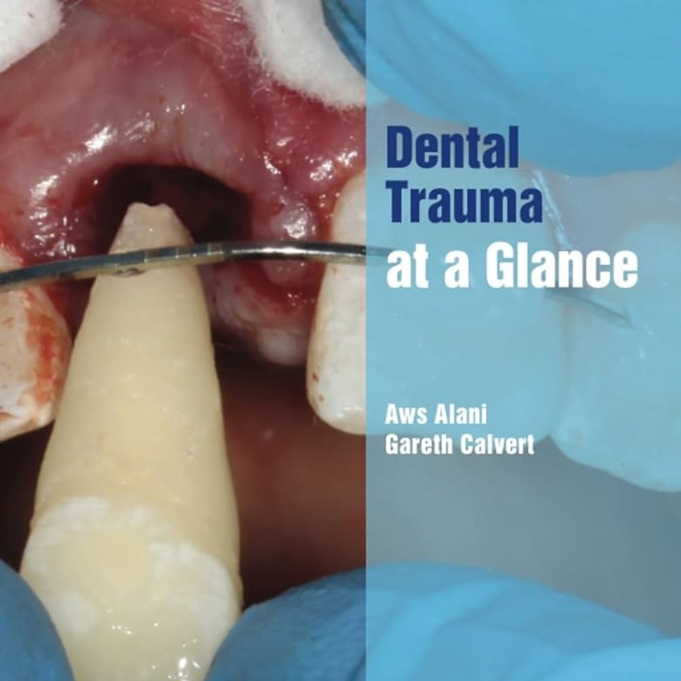 Dental Trauma at a Glance (At a Glance (Dentistry))