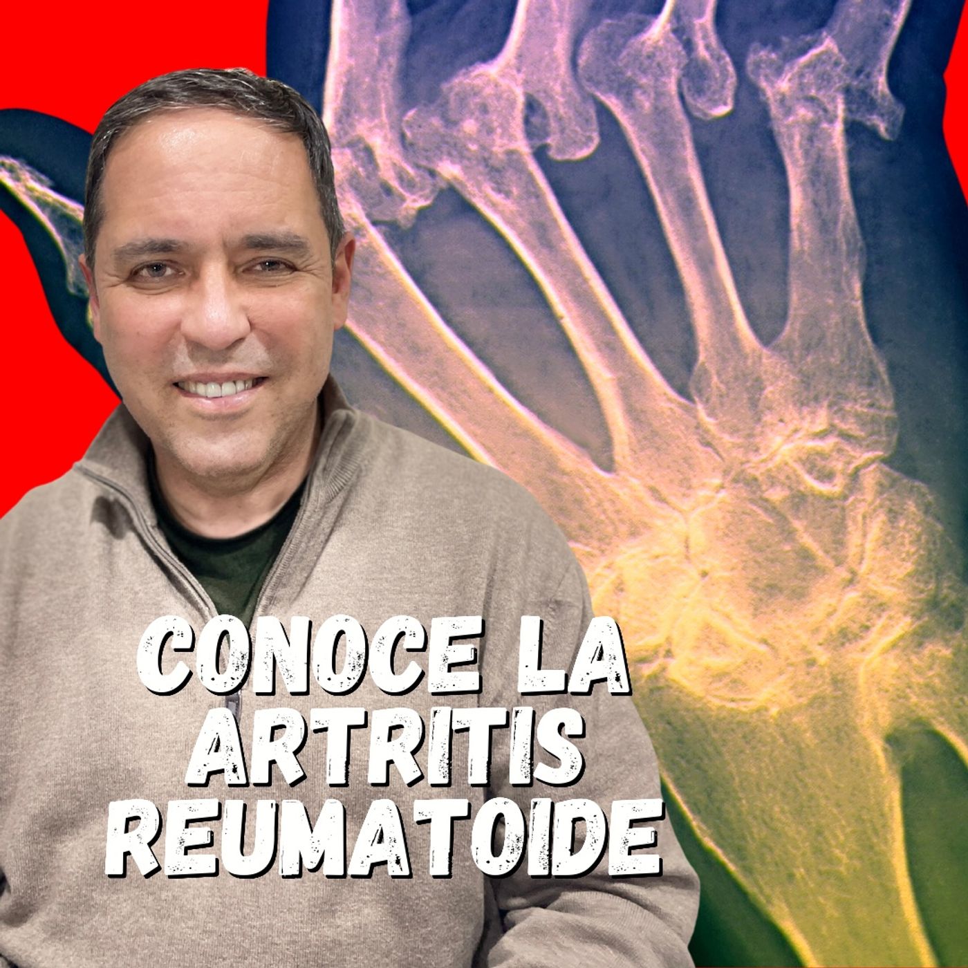 *** ARTRITIS REUMATOIDE, UNA ENFERMEDAD DISCAPACITANTE ***