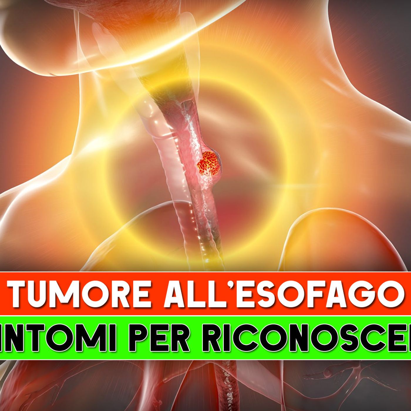 Tumore All'Esofago: I 5 Sintomi Per Riconoscerlo! episode artwork