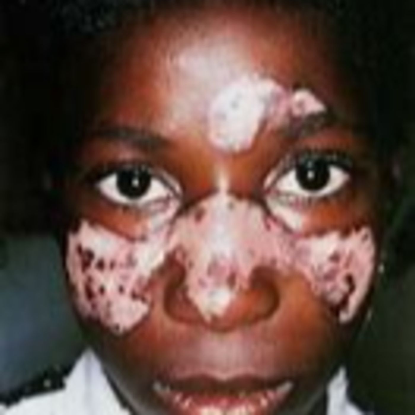 Susan Hendrix My Story Living With Lupus