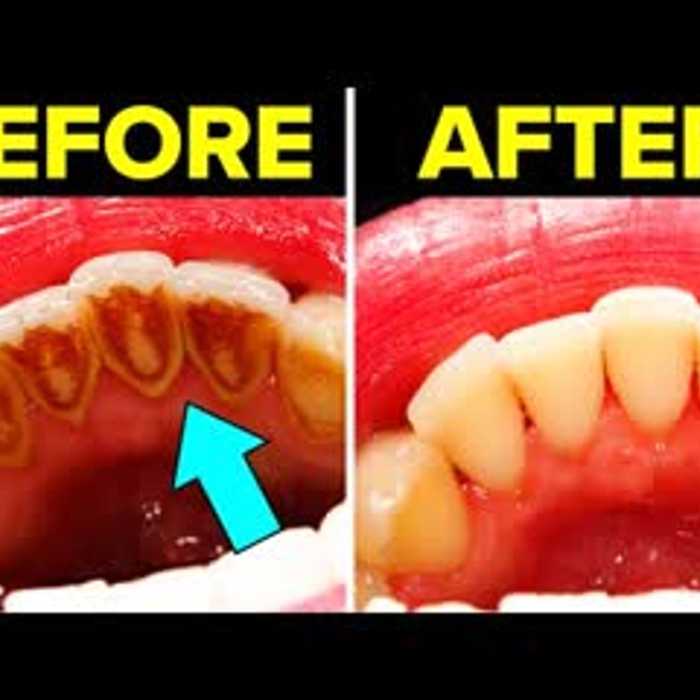 14 Remedies To Fight Against Plaque Naturally episode artwork