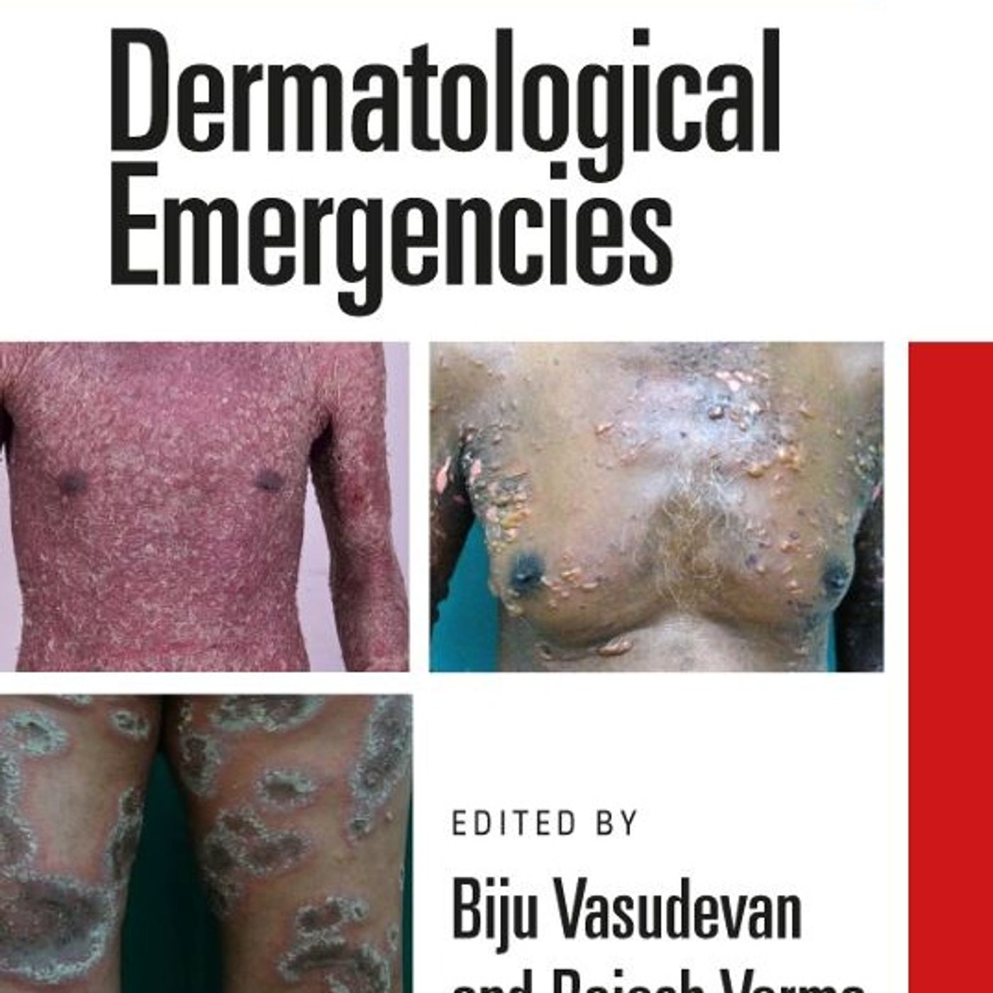 Dermatological Emergencies