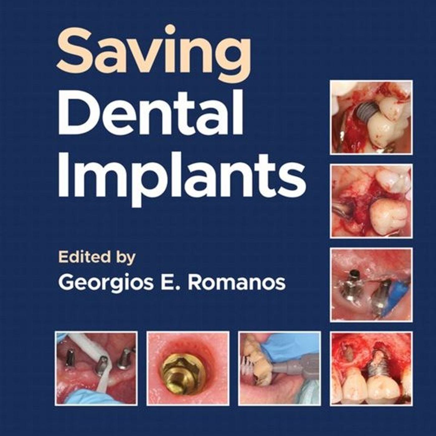 Saving Dental Implants