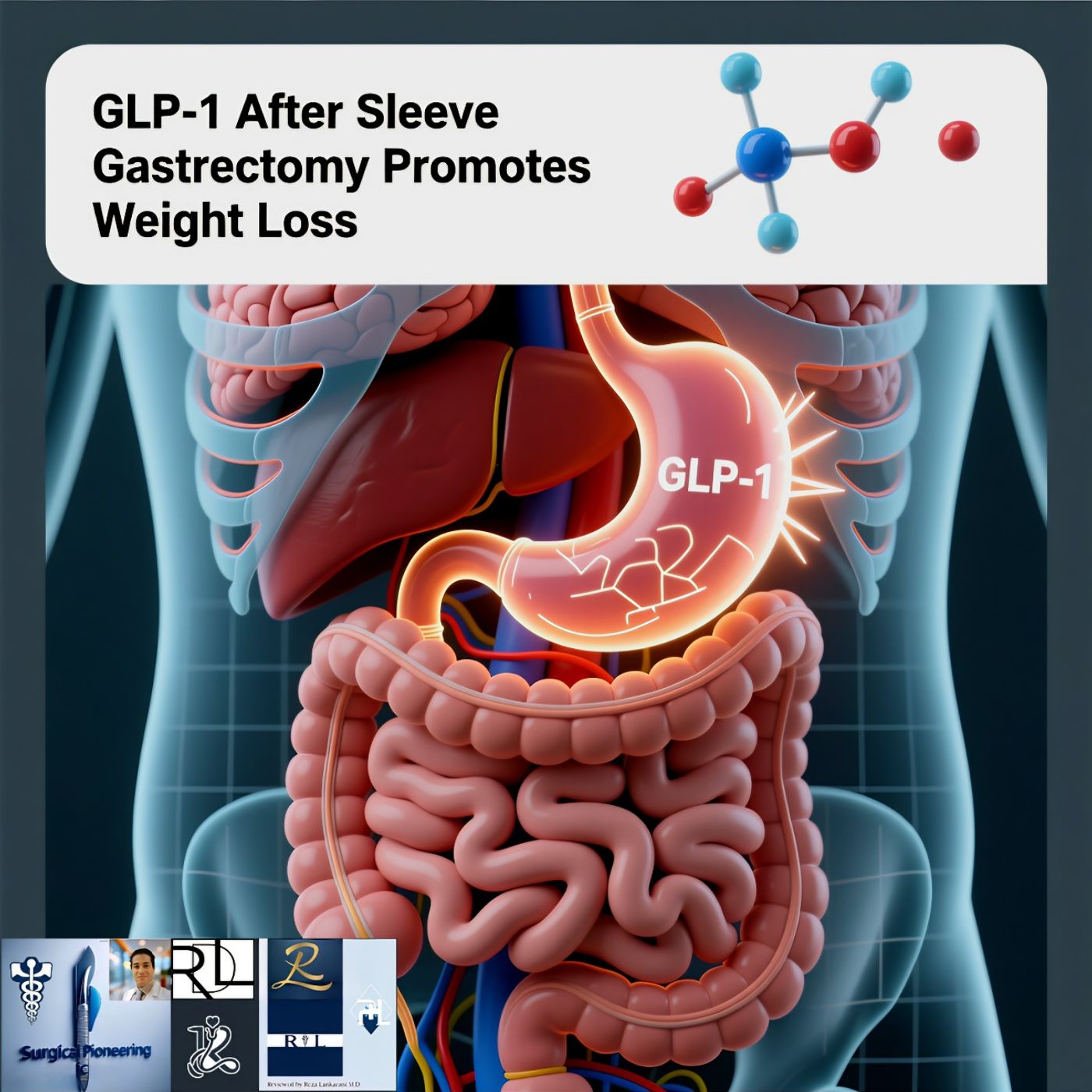 GLP-1 After Sleeve Gastrectomy Promotes Weight Loss episode artwork